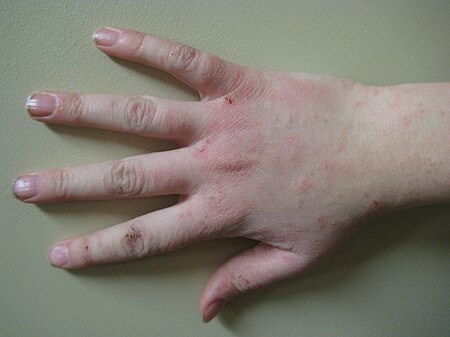 โรคผิวหนังอักเสบภูมิแพ้ (Atopic Dermatitis) เป็นโรคผิวหนังเรื้อรังที่มีลักษณะอาการกำเริบซ้ำบ่อย และมักพบในทารกและเด็กเล็ก โดยประมาณ 80% ของผู้ป่วยจะเกิดอาการก่อนอายุ 5 ปี (ภาพจากอินเทอร์เน็ต)